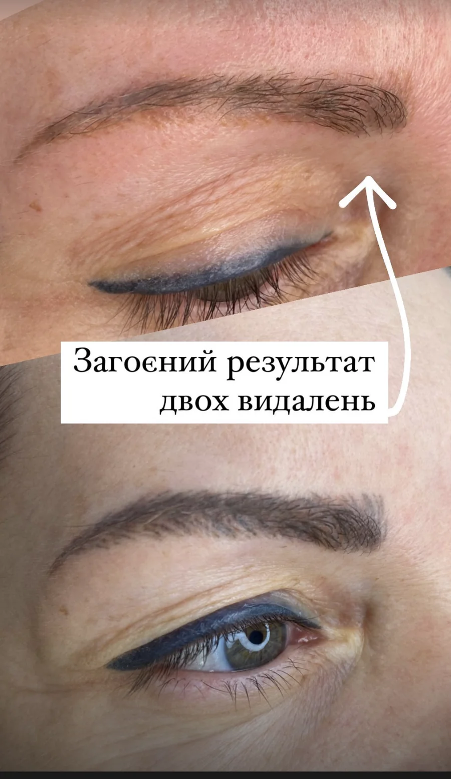 Результат лазерного видалення перманенту