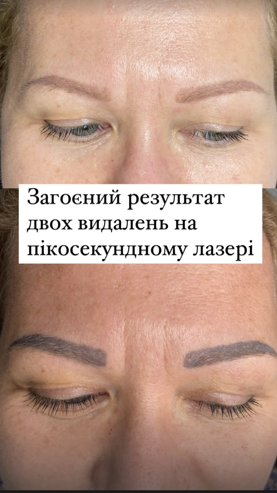 Результат лазерного видалення перманенту