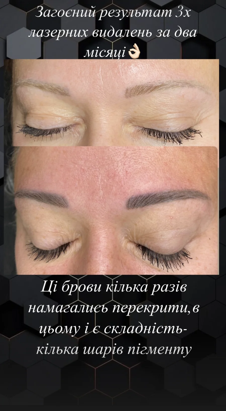 Результат лазерного видалення перманенту