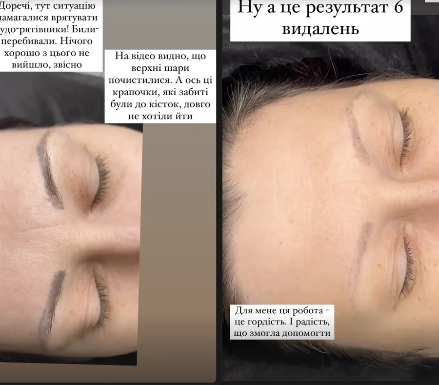 Результат лазерного видалення перманенту
